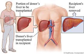 चित्र:Liver transplant.1jpg.jpg