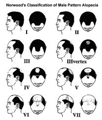 चित्र:Haire transplant1.jpg