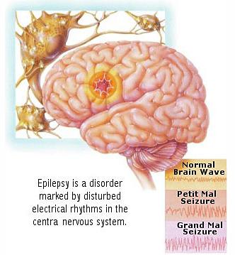 चित्र:Epilepsy-Treatment1.jpg