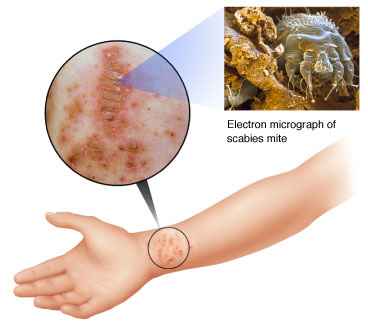 चित्र:Causes scabies.jpg