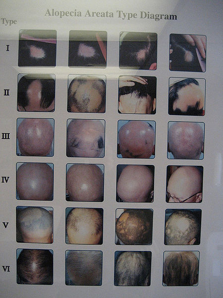 File:Baldness.jpg