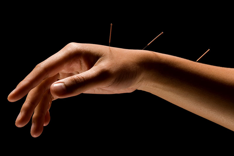 File:Acupuncture.jpg