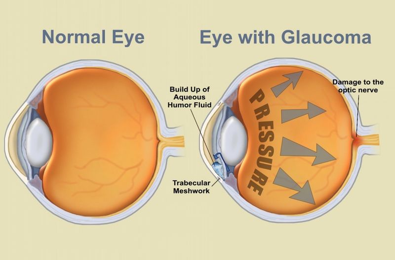 File:Eyes-Glaucoma.jpg